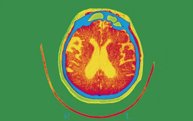 Quét não của một bệnh nhân bị ảnh hưởng bởi bệnh Alzheimer